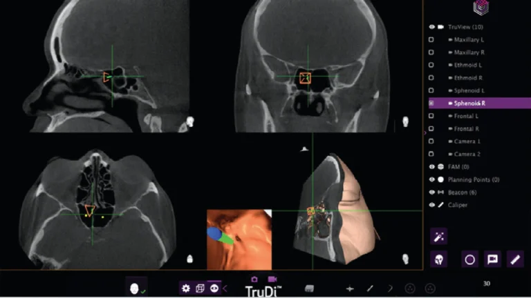 Adding AI to sinus surgery system saw malfunctions rocket from eight to 100 incidents, according to new investigation — skull-puncturing errors are the stuff of nightmares | Tom's HardwareTom's Hardware